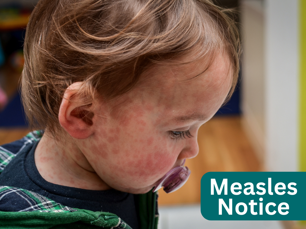 This is a photo of a young child with a red rash all over his face.